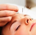 Acupuncture-Reduces-Stress.jpg